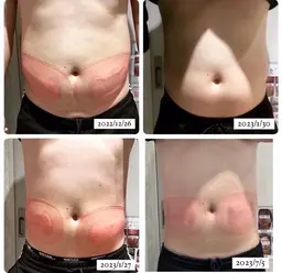 クールスカルプティング