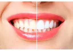 【初回限定💫特別価格】白い歯で自信溢れる笑顔に♪美容セルフホワイトニング🦷