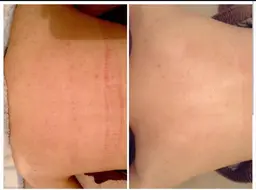 背中ニキビ・ニキビ痕•シミ•毛穴ダメージ回復ケア