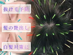 🔹ヘッドスパ鍼+リフトUP電気美容鍼🔹たるみケア・抜け毛予防・髪の艶出し・白髪対策に