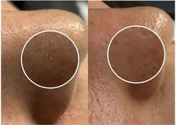 【2回目以降】😆黒ずみザラつき撃退コース❤️‍🔥