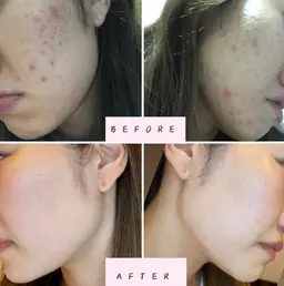 【韓国フェイシャル】本気の肌質改善!!