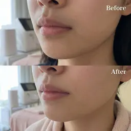 【お顔脱毛】つるん卵肌お顔脱毛　¥3,000