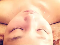 【美容鍼】【低刺激】💖小野小町コース❗️