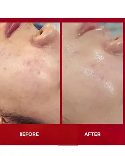 韓国白玉ピーリング