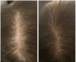 薄毛や抜け毛の根本改善💈⚗️お薬で無理矢理生やすのではなく根本を改善💡ヒト幹細胞培養上清液導入(前頭部)