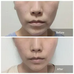 とにかくリフトアップしたい！フェイシャルリフトアップエイジングケア(エステティシャン施術)