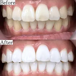 【👑人気No.1👑】5分照射×2回✨通常の2倍の照射パワーで効果実感‼️最先端のハイパワーセルフホワイトニング🦷✨