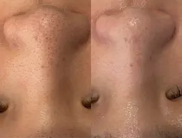 顔脱毛＋ハイドラ毛穴洗浄