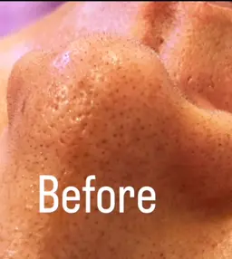 ソフトダーマand水素毛穴洗浄