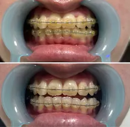 迷ったらこれ‼️【20〜30代向け】ホワイトニング&ハンドマッサージ付き