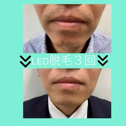 【男性限定】ヒゲ脱毛