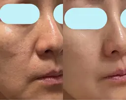 【女性専用】小顔コルギ＋小鼻毛穴洗浄＋ニードルハーブピーリング🩵最強エイジングケア💆‍♀️✨輪郭/美肌形成！