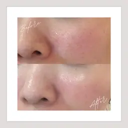 お得な初回限定【水光イオン導入+フェイシャルマッサージ付き】毛穴ぴかぴかうるおい水光肌へ✨