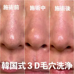 【圧倒的結果の出る毛穴洗浄】韓国式3D毛穴洗浄モニター募集