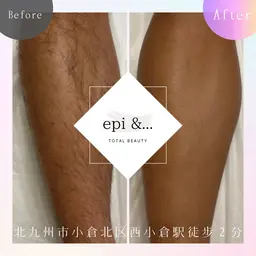 メンズ全身脱毛(顔＋VIO込)