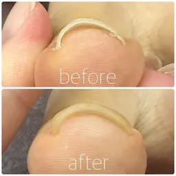 巻き爪ケアモデル