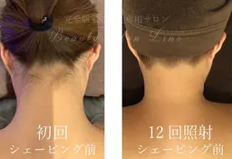 【背中脱毛&うなじ脱毛】シェービング&イオン導入付き🩵特別価格¥5500💕🤍🩵