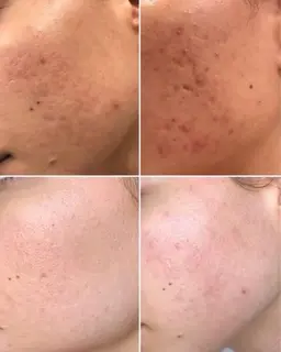 光フェイシャル60分コース