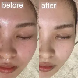 🫧minimo価格🫧 【毛穴ケア/くすみケア/保湿】感動の毛穴レス・トーンUP✨フェイシャルエステ