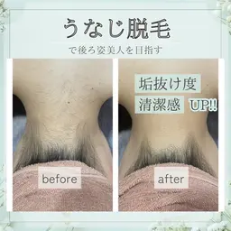 🎓卒業式の写真映え応援企画🌸【うなじ脱毛・顔脱毛・美肌エステ】選べるメニュー￥1980