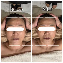 小顔フェイスリフトアップコース 2回目 ￥21,000