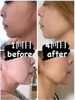 小顔痩身　4回分🌹小顔、お顔引き上げ、たるみ、浮腫解消🔥