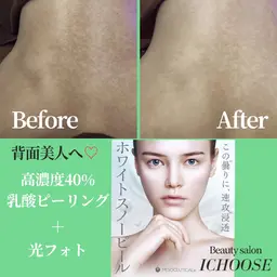 【🌹人に見せたくなる背中へ♡🌻】背中全体スペシャル〈光フォト+乳酸ピーリング+海藻パック〉