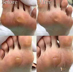 【足裏タコ魚の目ケア】足裏のかた​〜​い角質も🦶💦いた​〜​い魚の目も😩すっかりさよなら👋✨しましょう🤗