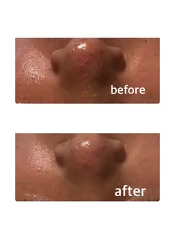 毛穴スッキリ透明感アップ⤴️コース