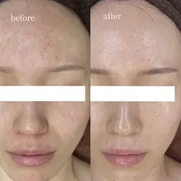 平日限定【圧倒的人気No. 1】水光ピーリング　¥19,800→¥8,800