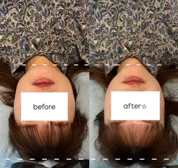 美容鍼 (顔，頭) 🦔🌿🪡