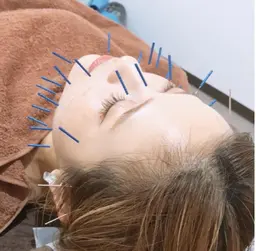 大好評につき11月も継続✨平日の12時〜17時限定✨美容鍼＋顔の電気鍼＋小顔ストレッチ