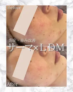 💆‍♀️最強たるみケア🔥サーマトリックス900shot＋水玉リフティングLDM🫧or選べる美容液アクアダーマ導入❕