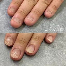 深爪矯正リペア※三週間以内