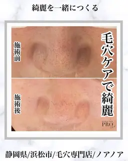 【ミニモ限定】黒ずみ毛穴ケア|毛穴エクストラクション