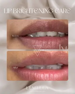 ｜ルメラ｜黒ずみ・メラニンケア｜リップモニター¥44000（通常価格¥55000）💋