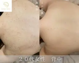 【美肌ケア背中ハーブピーリング✨】(皮むけなし💎)33,000→10,000円