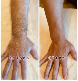 【メンズ】  全身脱毛(顔・VIO込)