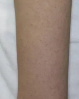 【二の腕ブツブツザラザラケア】剥けないハーブピーリング＋生酵素