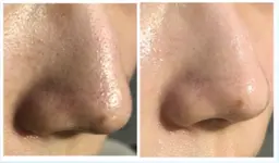 Tゾーン👃🏻の毛穴黒ずみに❕ハイドラ毛穴洗浄+保湿パック✨