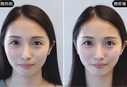 【ブライダル・撮影前】顔と体を整える 神小顔美容鍼