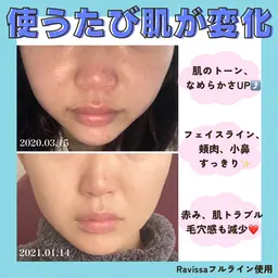 【ホームケア・スキンケアアドバイス】 💎美肌効果が高く、お肌の土台から整え透明感がUP⤴︎するラヴィーサ化粧品使用🌸