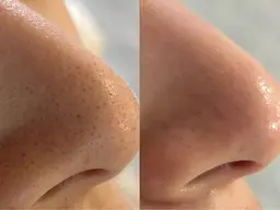 【毛穴悩み卒業!/本気で変わりたい方】毛穴ごっそり洗浄体験❤️🔥✨