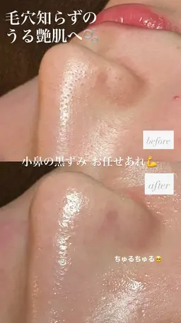 《歴5年staff施術》韓国艶肌フェイシャル ¥8,800 → ¥4,500 ハイドロ毛穴洗浄＋ヒト幹細胞