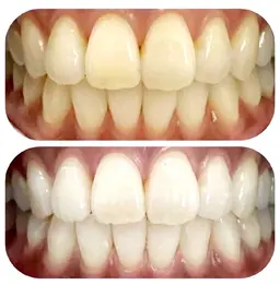 お子様でも痛くない！セルフホワイトニング🦷✨１日で完了コース(モニター価格)  8分×8セット