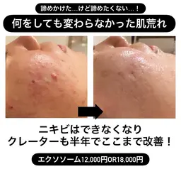 【本気の肌改善エステ】人気no.1