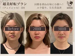 《人気No.1》本格小顔★医師監修リフトアップマシン＋小顔矯正＋骨盤矯正