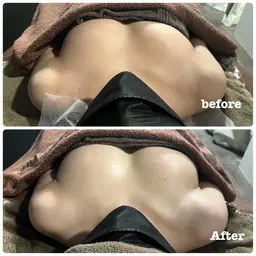 【🔥もうすぐ締切🔥】💓光覚醒バストアップトリートメント💓(美容液導入+光豊胸)