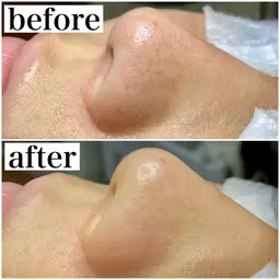 限定🫧毛穴エクストラクションプロ💆‍♀️✨